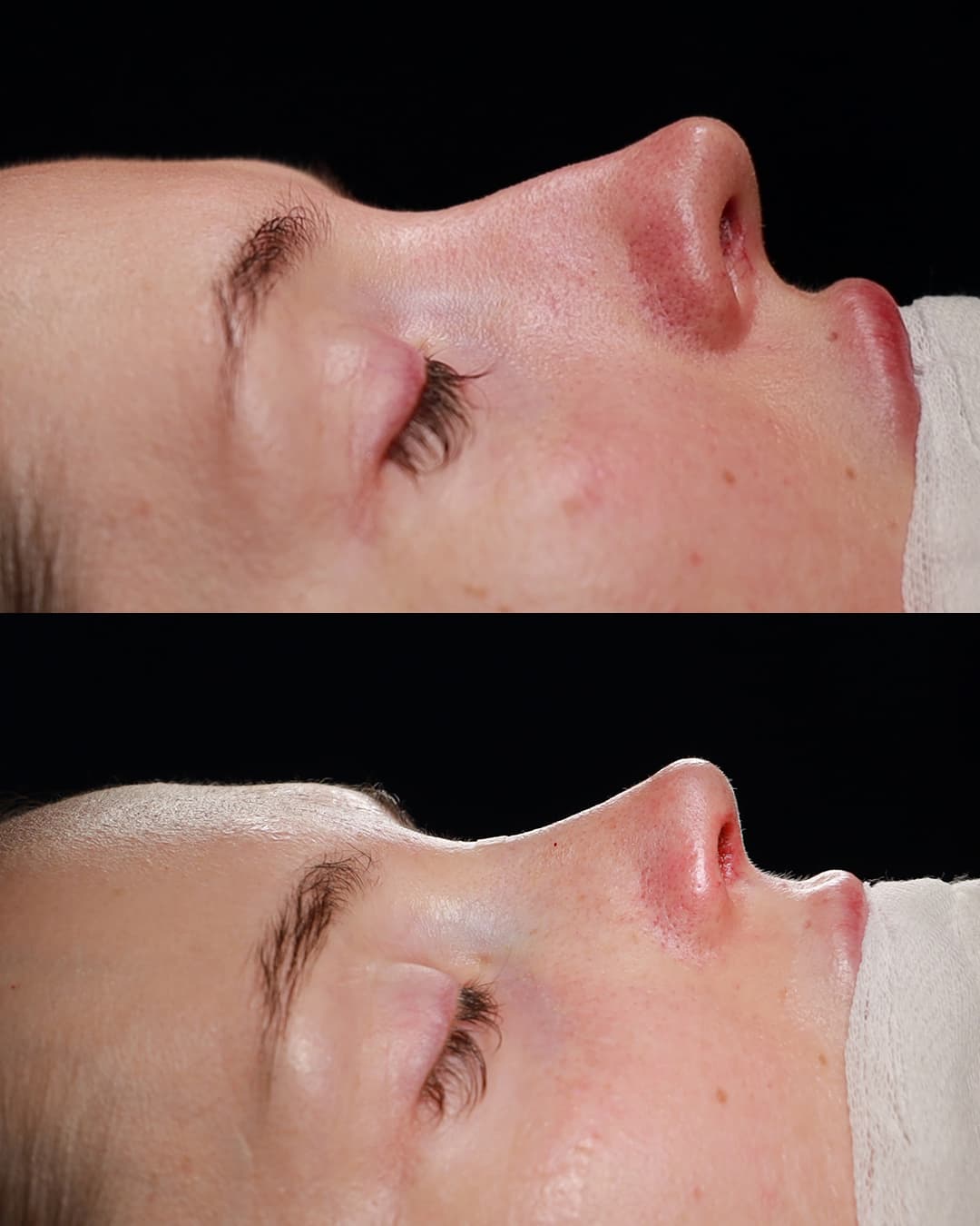 Primary Rhinoplasty Patient 3