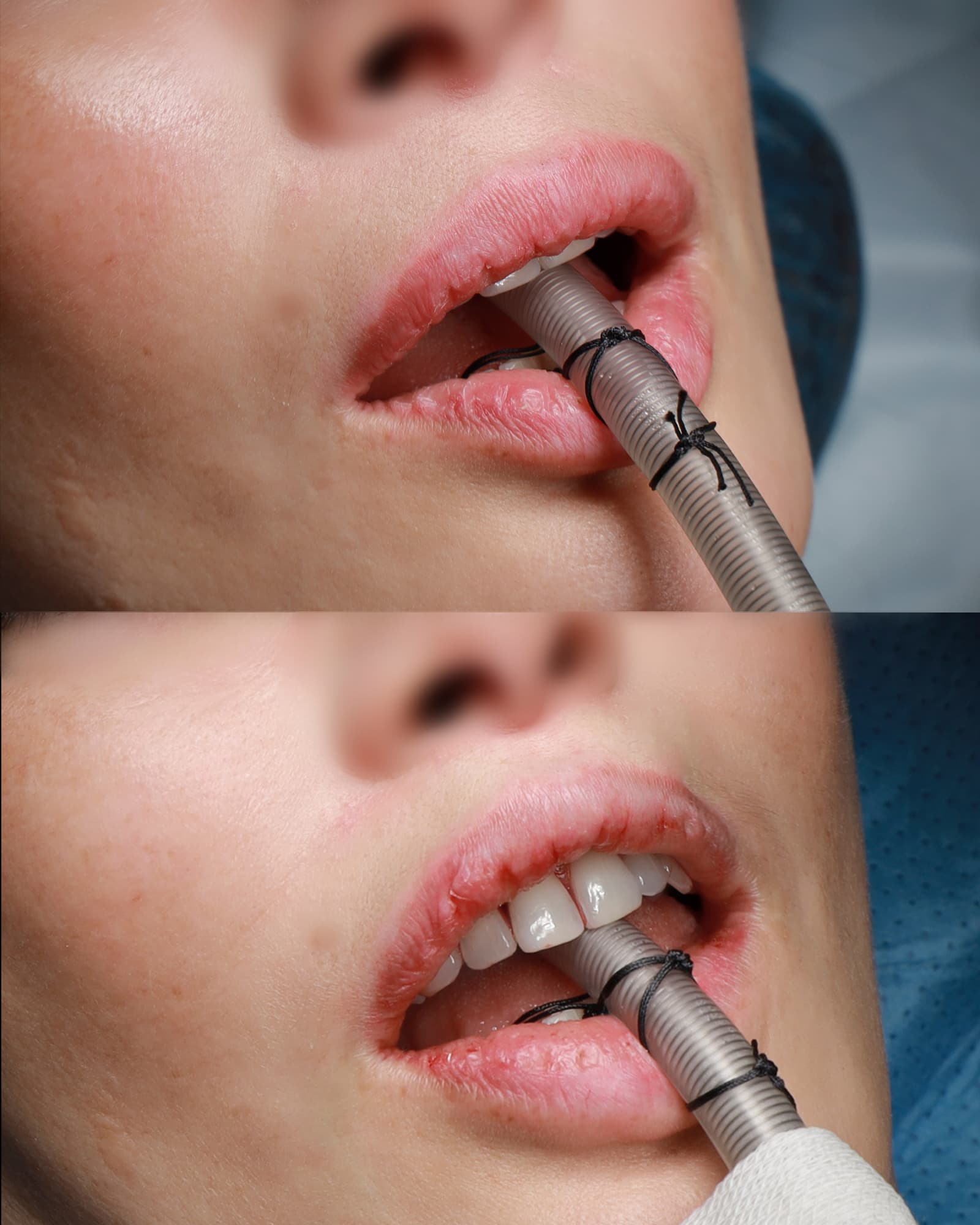 Scarless Lip Lift Patient 1